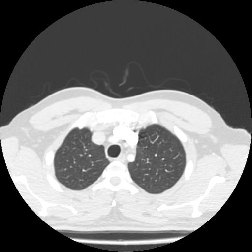File:Bronchial carcinoid (Radiopaedia 80013-93291 Axial lung window 10).jpg
