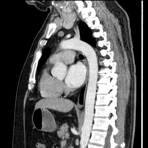Bronchial carcinoid tumor (Radiopaedia 67377-76764 E 38).jpg