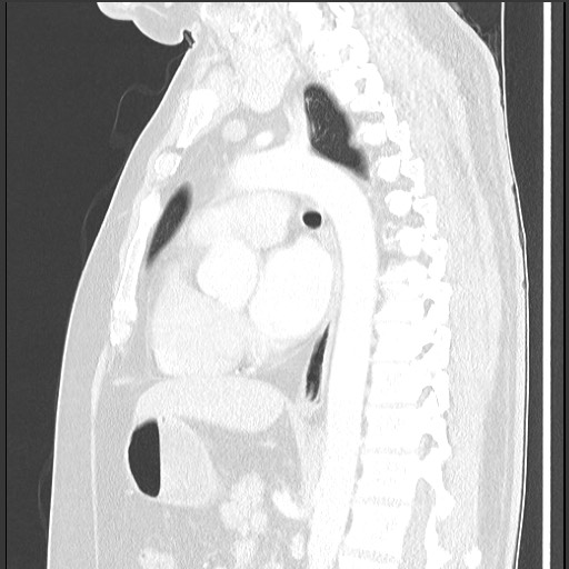 File:Bronchial carcinoid tumor (Radiopaedia 67377-76764 Sagittal lung window 38).jpg