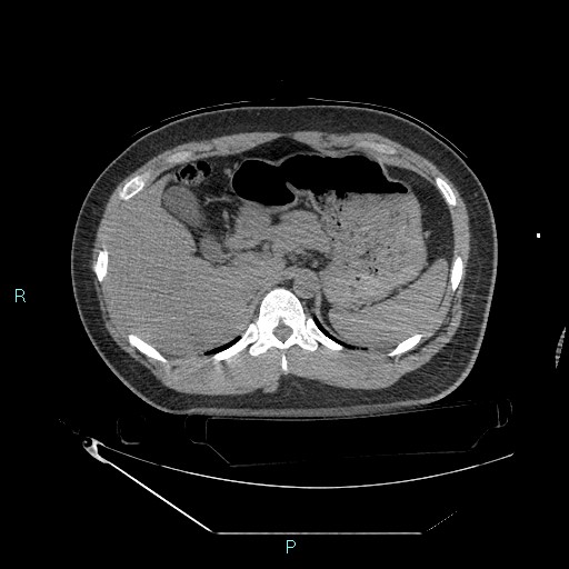 Bronchial carcinoid tumor (Radiopaedia 78272-90870 Axial non-contrast 107).jpg