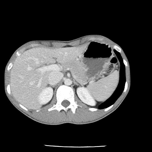 Bronchial carcinoid tumor causing right lower lobe collapse (Radiopaedia 83495-98594 A 55).jpg
