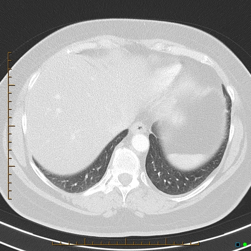 Bronchial diverticula (Radiopaedia 79512-92675 Axial lung window 40).jpg