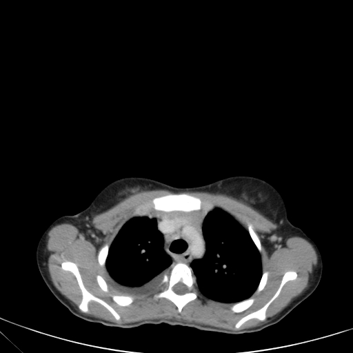 Bronchial mucoepidermoid carcinoma (Radiopaedia 57023-63895 Axial 28).jpg