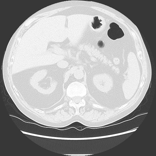 Bronchial stenosis - lung transplant (Radiopaedia 73133-83848 Axial lung window 62).jpg