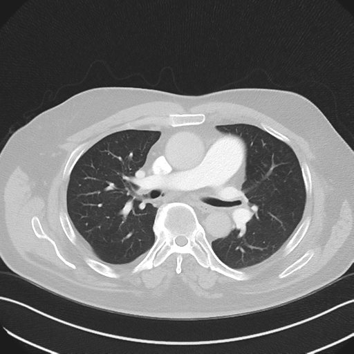 File:Bronchiectasis (Radiopaedia 39385-41666 Axial lung window 29).png