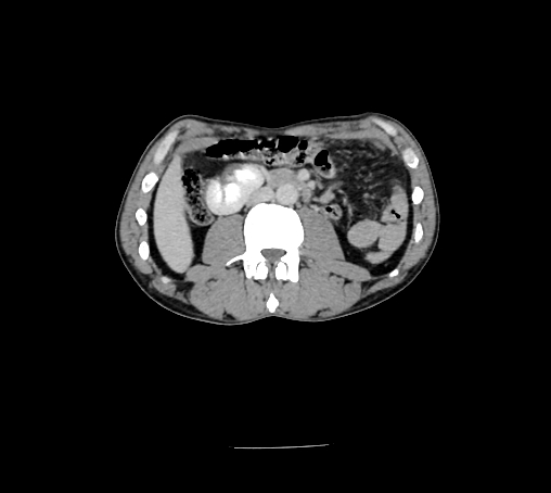 Bronchiectasis in Crohn disease (Radiopaedia 60311-67977 B 84).jpg