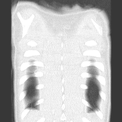 File:Bronchiolotis obliterans (Radiopaedia 73769-84575 Coronal lung window 36).jpg