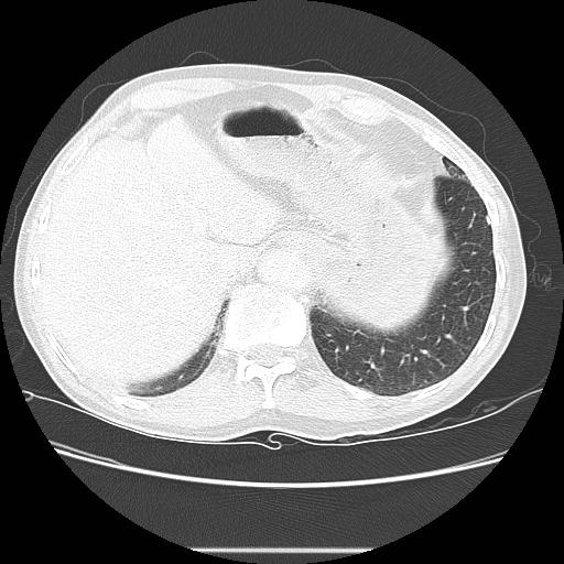 File:Bronchocele (Radiopaedia 17097-16795 Axial lung window 103).jpg