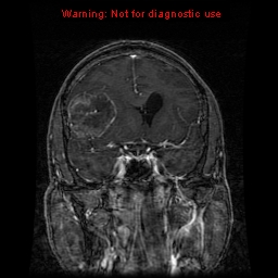 File:Bronchogenic carcinoma brain metastasis (Radiopaedia 9286-9969 Coronal T1 25).jpg