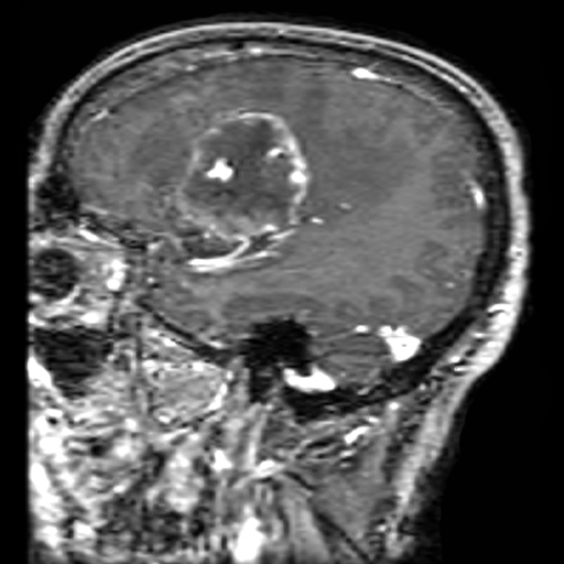 File:Bronchogenic carcinoma brain metastasis (Radiopaedia 9286-9970 C 1).jpg