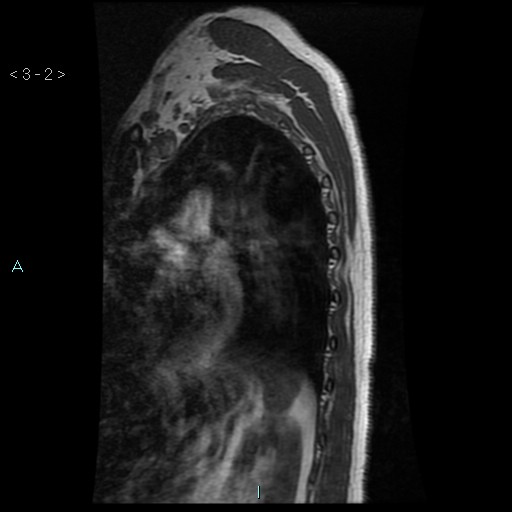 File:Bronchogenic cyst - posterior mediastinal (Radiopaedia 43885-47365 Sagittal T1 2).jpg
