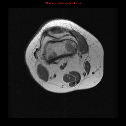 File:Brown tumor (Radiopaedia 12318-12597 Axial T1 2).jpg