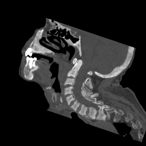 File:Brown tumor with secondary hyperparathyroidism (Radiopaedia 23591-23705 B 4).jpg