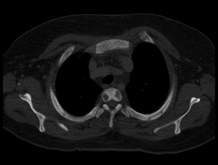 File:Brown tumors compressing the spinal cord (Radiopaedia 68442-77988 Axial bone window 15).jpg
