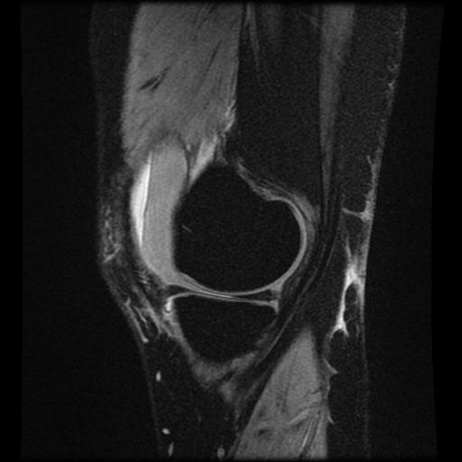 Bucket handle meniscus tear (Radiopaedia 56916-63751 H 66).jpg