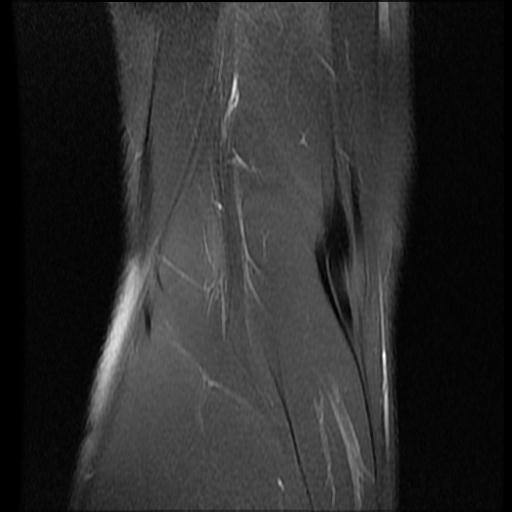 File:Bucket handle tear - lateral meniscus (Radiopaedia 72124-82634 Coronal PD fat sat 16).jpg