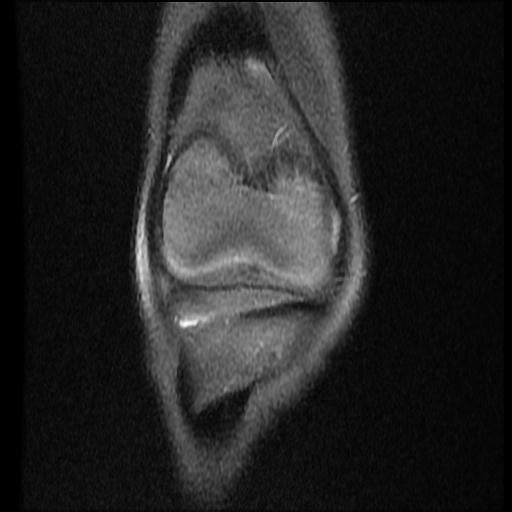 File:Bucket handle tear - lateral meniscus (Radiopaedia 72124-82634 Coronal PD fat sat 4).jpg