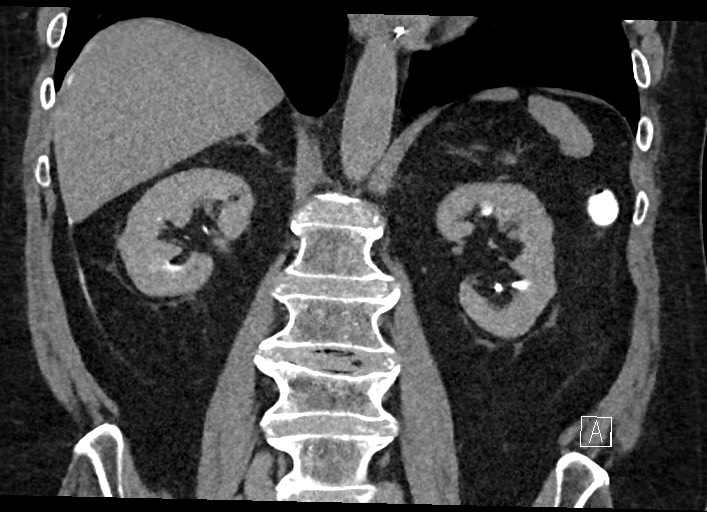 Buried bumper syndrome - gastrostomy tube (Radiopaedia 63843-72577 Coronal Inject 85).jpg