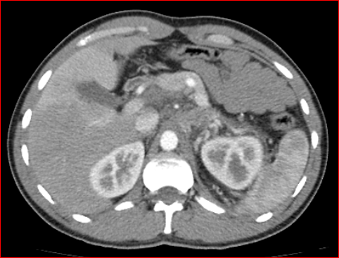 File:Burned-out testicular choriocarcinoma (Radiopaedia 32822-34040 B 3).PNG