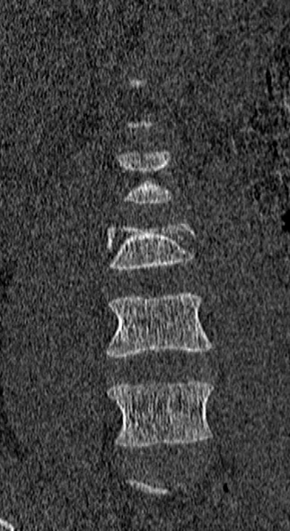 Burst fracture (Radiopaedia 53373-59357 Coronal bone window 12).jpg