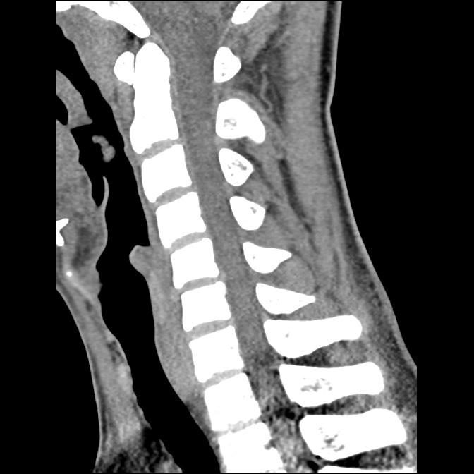 C5 facet fracture (Radiopaedia 58374-65499 D 37).jpg