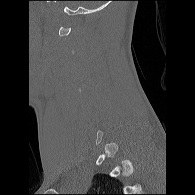 C5 facet fracture (Radiopaedia 58374-65499 Sagittal bone window 52).jpg