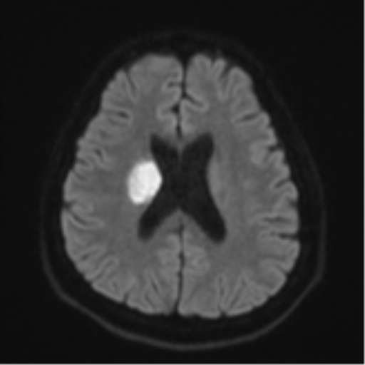 File:CNS vasculitis (Radiopaedia 55715-62263 Axial DWI 48).png