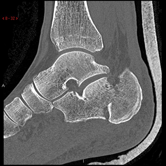File:Calcaneal fracture and associated spinal injury (Radiopaedia 17896-17656 Sagittal bone window 1).jpg