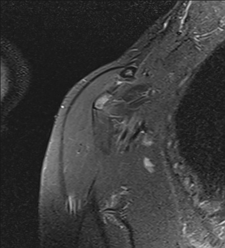 File:Calcific tendinitis of the infraspinatus tendon (Radiopaedia 87256-103537 Coronal PD fat sat 4).jpg