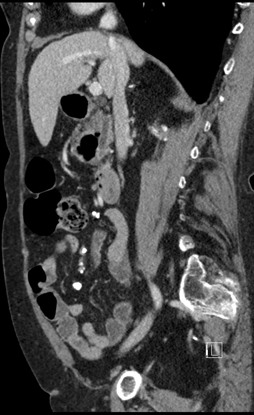 Calcified adrenal glands and Spigelian hernia (Radiopaedia 49741-54988 C 99).jpg