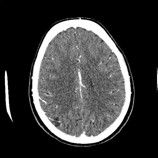 Calcified cerebral hydatid cyst (Radiopaedia 65603-74717 Axial with contrast 53).jpg