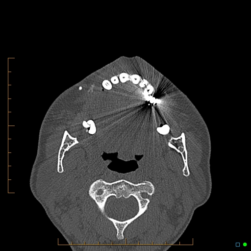 Calcified facial augmentation fillers (Radiopaedia 79514-92679 Axial bone window 99).jpg