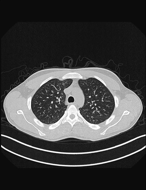 Calcifying pulmonary metastases (Radiopaedia 33359-34396 Axial lung window 18).jpg