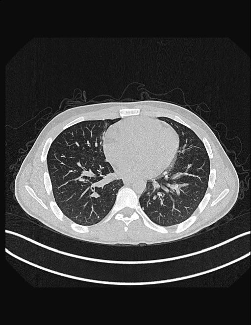 Calcifying pulmonary metastases (Radiopaedia 33359-34396 Axial lung window 39).jpg