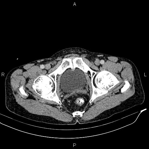 Caput medusae sign - portal hypertension (Radiopaedia 64007-72759 A 98).jpg