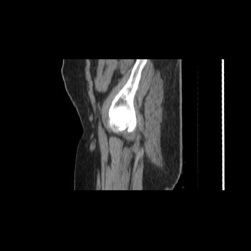 File:Carcinoma cervix- brachytherapy applicator (Radiopaedia 33135-34173 D 8).jpg