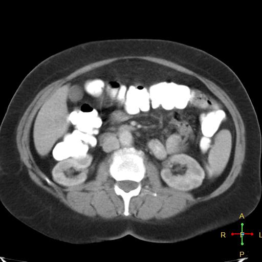 File:Carcinoma of sigmoid colon (Radiopaedia 23071-23100 B 9).jpg