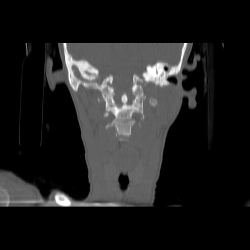 Carcinoma of the maxillary antrum (Radiopaedia 53805-59888 Coronal bone window 97).jpg