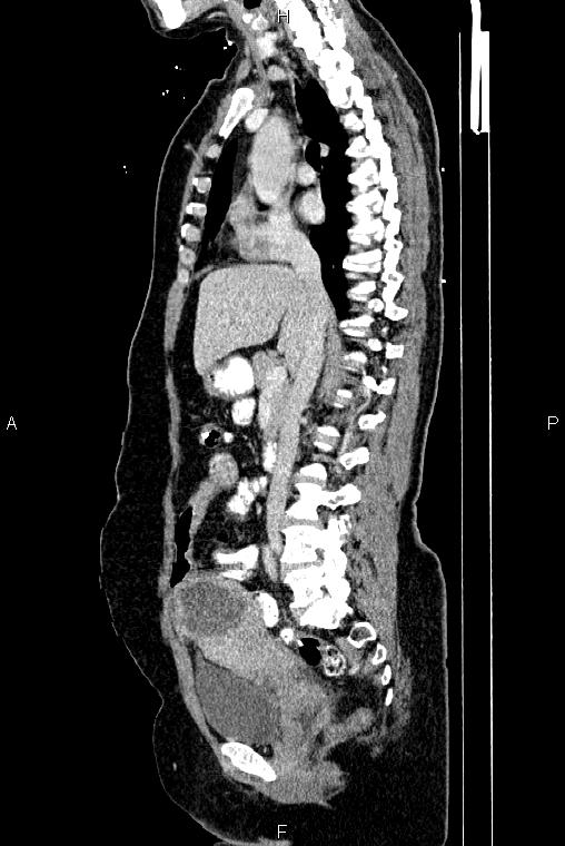Carcinoma of uterine cervix (Radiopaedia 85861-101700 D 36).jpg