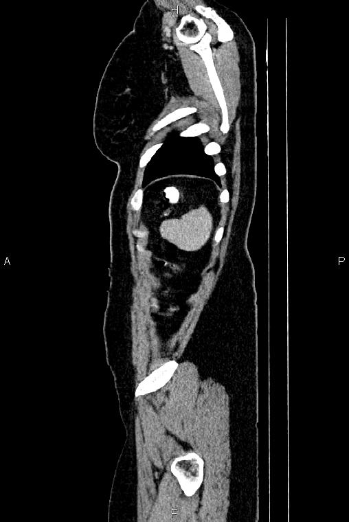 Carcinoma of uterine cervix (Radiopaedia 85861-101700 D 82).jpg