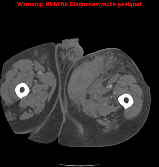 File:Cardiac perforation following transcatheter aortic valve implantation (Radiopaedia 23714-23863 B 31).png