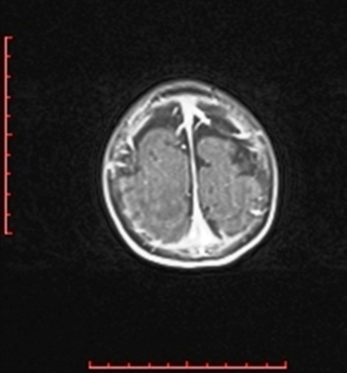 Cardiac rhabdomyoma - tuberous sclerosis (Radiopaedia 70089-80114 Axial T1 C+ fat sat 100).jpg