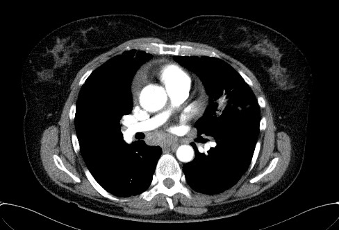 Cardiac sarcoidosis (Radiopaedia 74548-85534 A 40).jpg