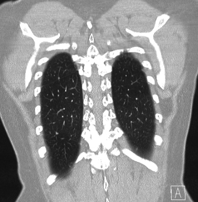 Cardiac sarcoidosis (Radiopaedia 74548-85534 Coronal lung window 60).jpg