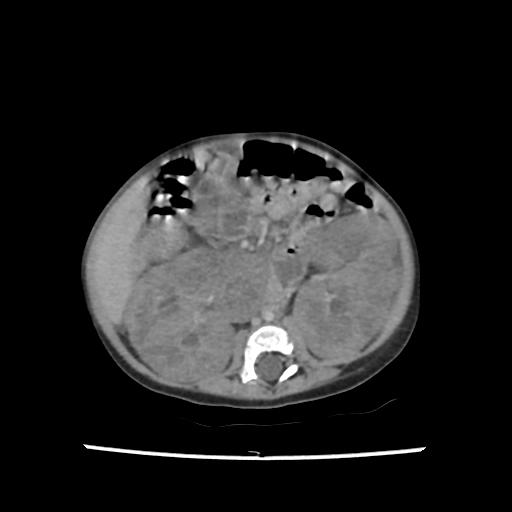 File:Caroli disease with autosomal recessive polycystic kidney disease (ARPKD) (Radiopaedia 89651-106703 B 123).jpg
