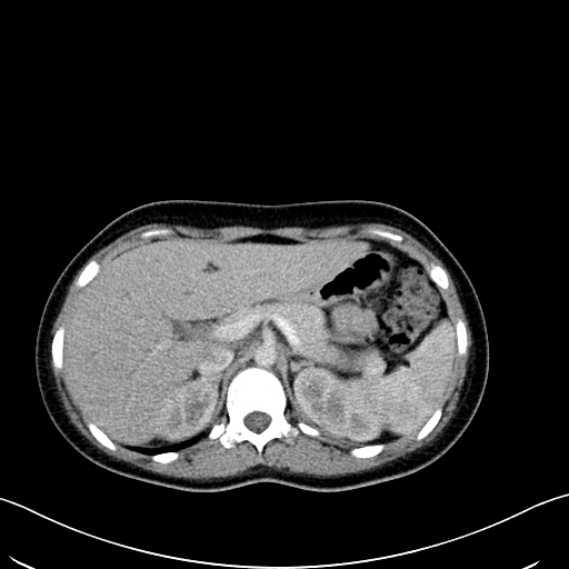 Caroli disease with medullary sponge kidney (Radiopaedia 82622-96804 C 22).jpg