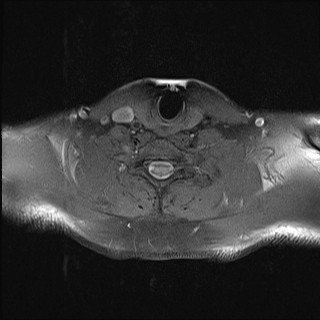 File:Carotid artery dissection (Radiopaedia 28441-28689 Axial T1 fat sat 11).jpg
