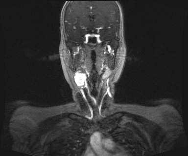 Carotid body tumor (Radiopaedia 12777-12912 MRA 24).jpg