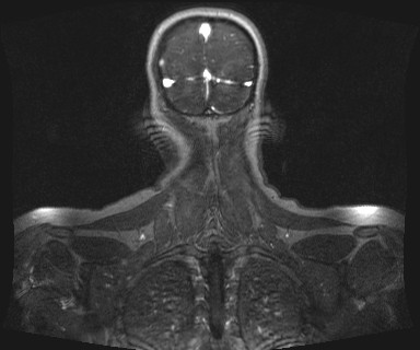 Carotid body tumor (Radiopaedia 12777-12912 MRA 72).jpg