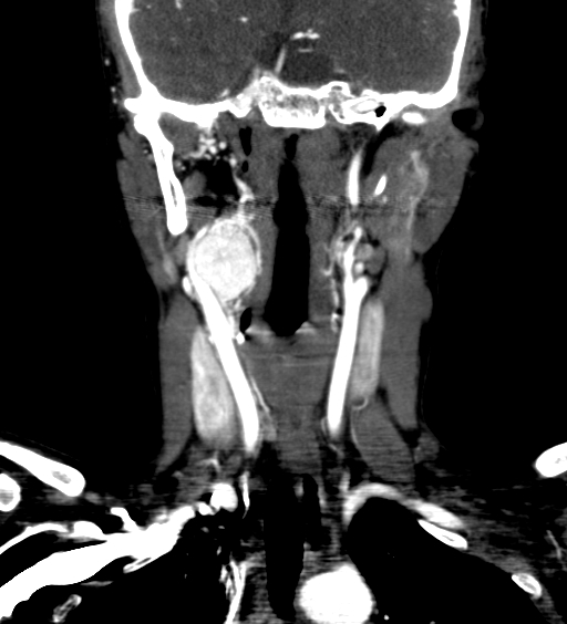 File:Carotid body tumor (Radiopaedia 39845-42300 C 31).jpg